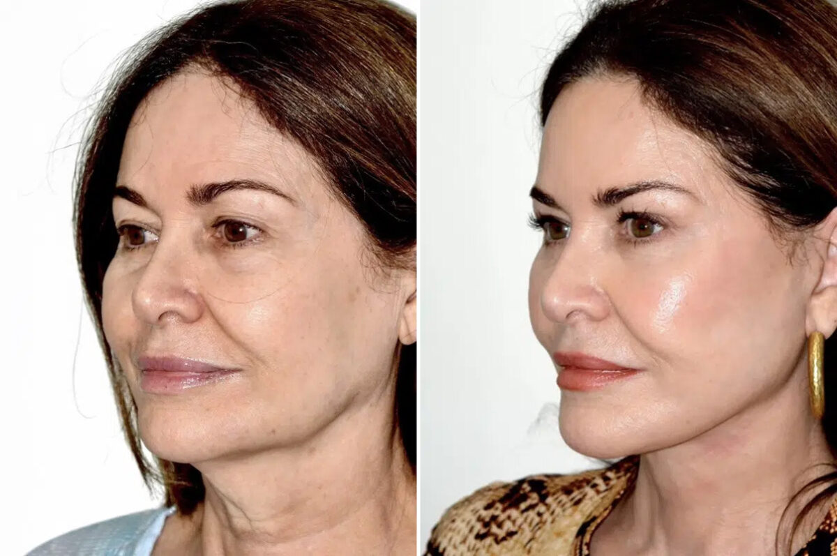 Lifting facial (facelift) fFotos de Antes y Después en Miami, FL, Paciente 17869