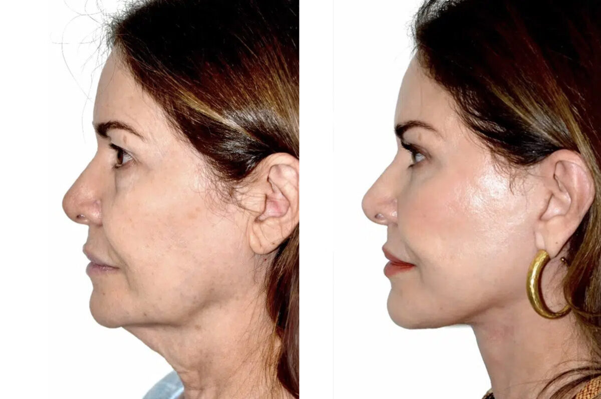 Lifting facial (facelift) fFotos de Antes y Después en Miami, FL, Paciente 17869