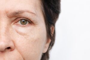 Primer plano del ojo de una mujer madura mostrando bolsas y líneas de expresión, signos que se evalúan para una blefaroplastia.