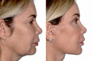 Fotos de antes y después del perfil de una paciente mostrando un contorno facial rejuvenecido tras un lifting.