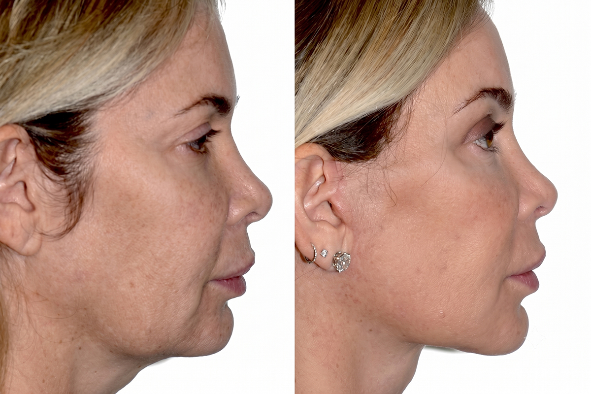 Fotos de antes y después del perfil de una paciente mostrando un contorno facial rejuvenecido tras un lifting.
