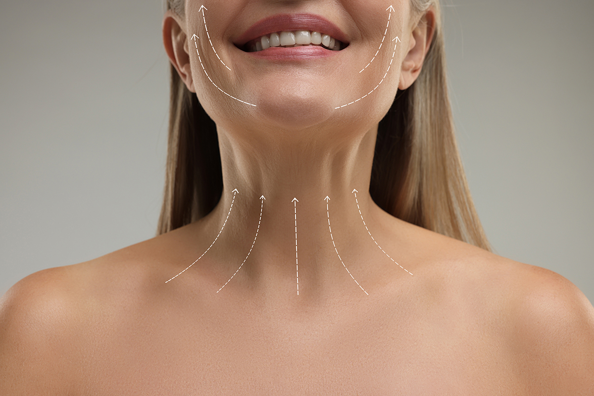 Parte inferior del rostro y cuello con flechas que ilustran los efectos de elevación de los procedimientos de lifting de plano profundo frente al lifting de cuello.
