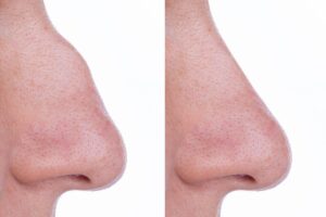 Comparación de perfil antes y después de una rinoplastia, mostrando la reducción de la giba dorsal para lograr un puente nasal recto.