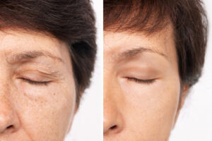Comparación de antes y después del área del ojo de una mujer madura con el párpado cerrado, mostrando la reducción de arrugas y piel sobrante tras una blefaroplastia.