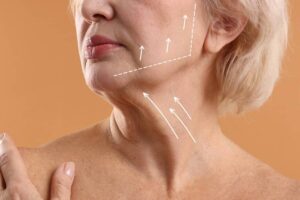 Primer plano del cuello y mandíbula de una mujer con flechas indicando los vectores del lifting facial.
