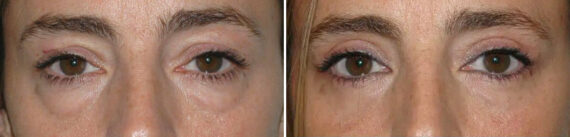 Blefaroplastia (párpados) fFotos de Antes y Después en Miami, FL, Patient 9870