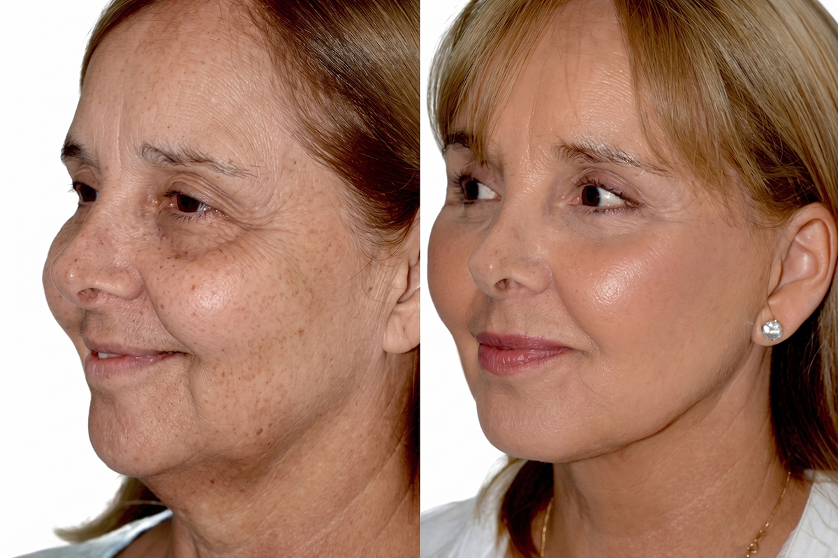 Fotos de antes y después de un lifting facial mostrando piel más tersa y mejor definición.