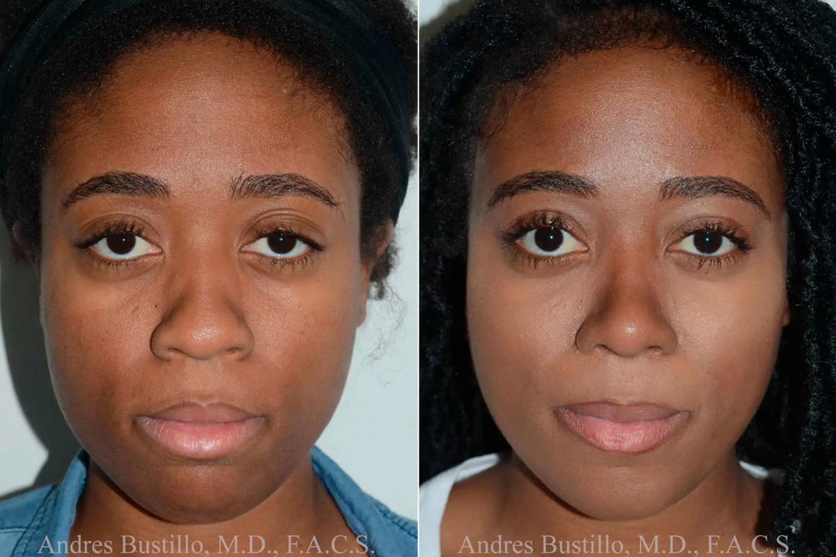 Comparación fotográfica frontal de antes y después de una paciente afrodescendiente mostrando los resultados de refinamiento de una rinoplastia étnica.